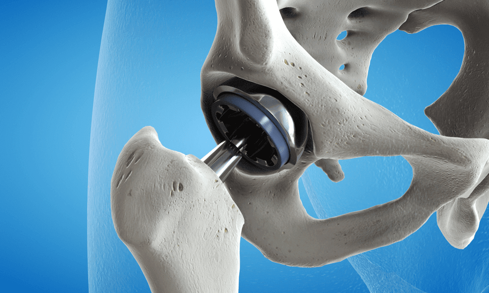 Consult Anjani Kumar, One of the best Hip Replacement surgery in Hyderabad.Hip Replacement treatment in Hyderabad