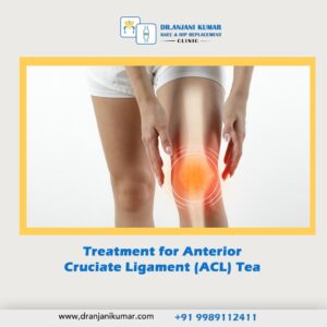 Read more about the article Treatment for Anterior Cruciate Ligament (ACL) Tear