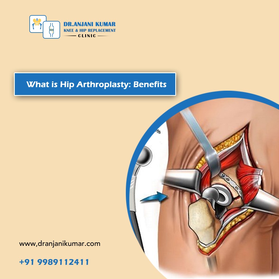 Read more about the article What is Hip Arthroplasty: Benefits