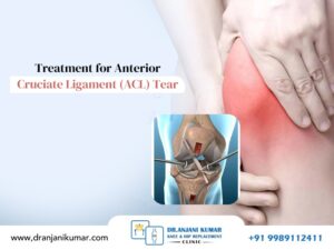 Read more about the article Treatment for Anterior Cruciate Ligament (ACL) Tear