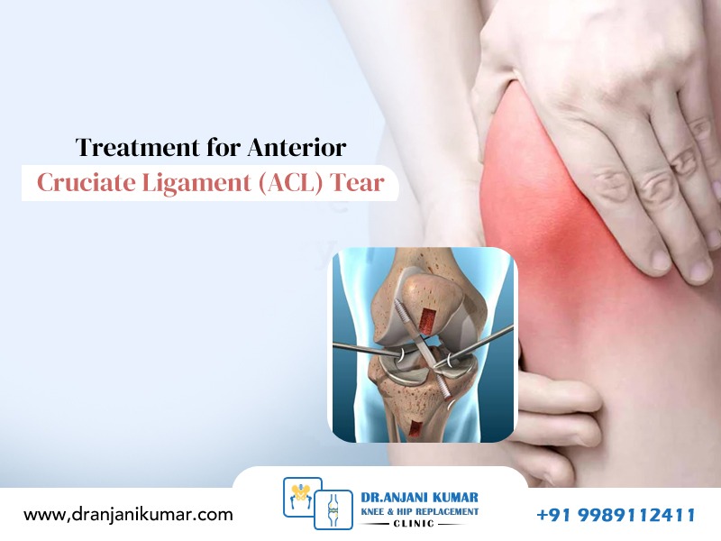 Read more about the article Treatment for Anterior Cruciate Ligament (ACL) Tear