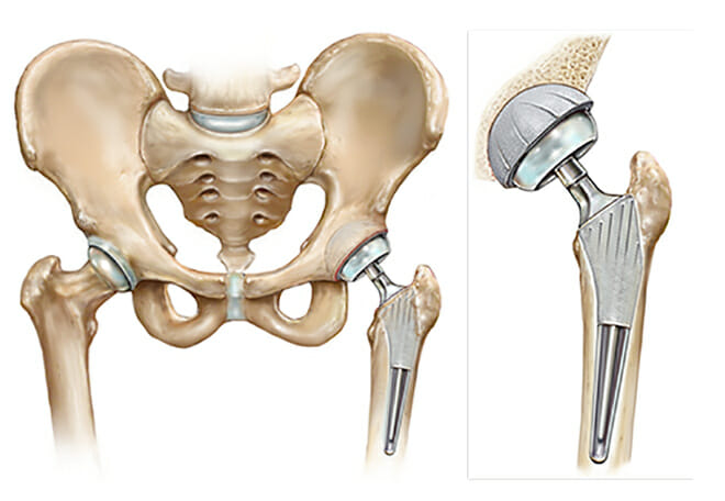 Book an appointment with Dr Anjani Kumar for Total Hip replacement surgery in Hyderbad
