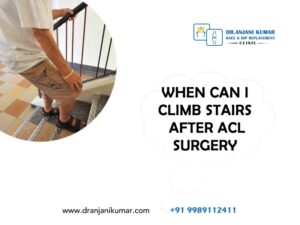 Read more about the article When can I climb stairs after ACL surgery