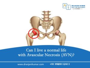 Read more about the article Can I live a normal life with Avascular Necrosis (AVN)?