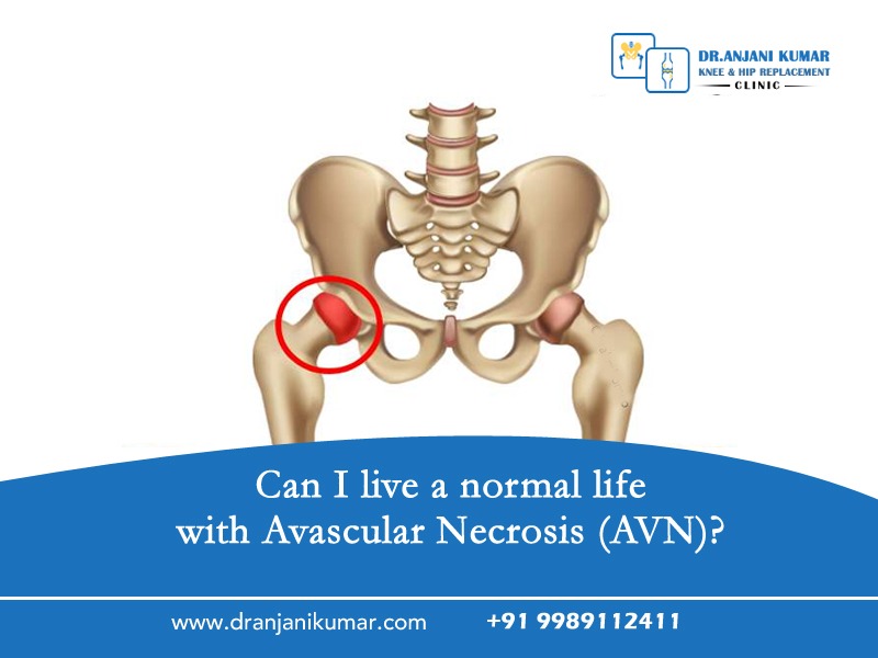 Read more about the article Can I live a normal life with Avascular Necrosis (AVN)?