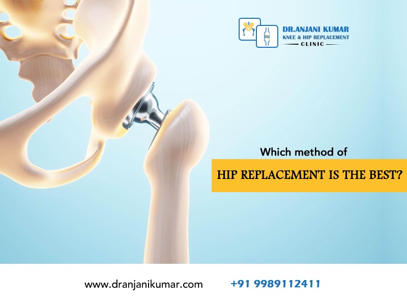 Read more about the article Which method of hip replacement is the best?