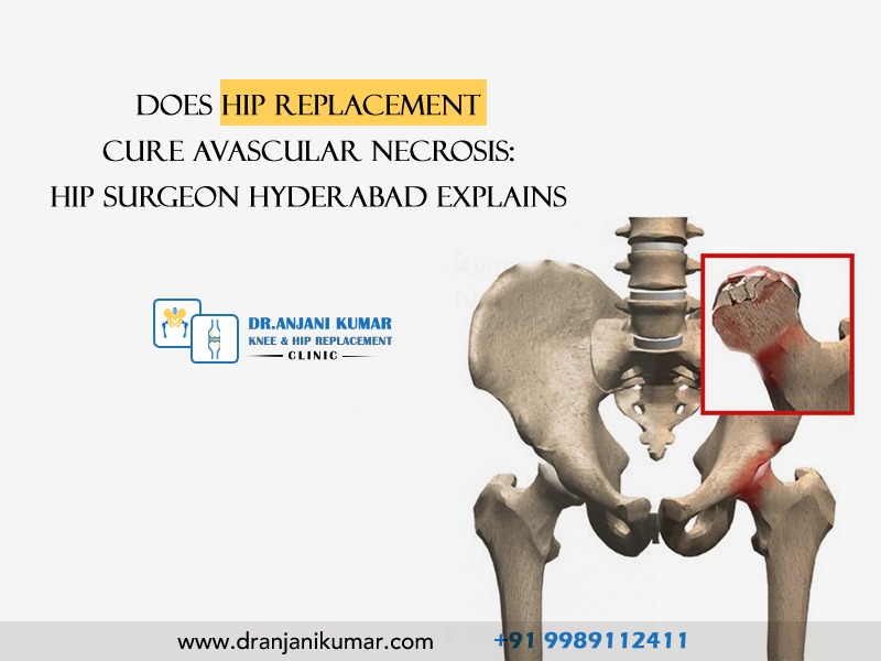Read more about the article Does hip replacement cure avascular necrosis: Hip Surgeon Hyderabad explains