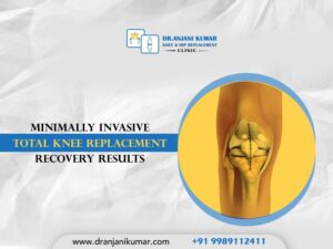 Read more about the article Minimally invasive total knee replacement recovery results
